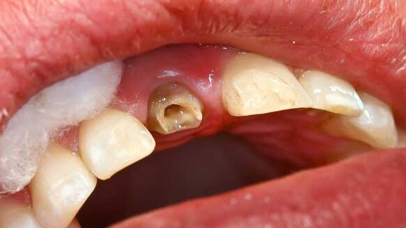 Implant site preservation using a novel post and crown
