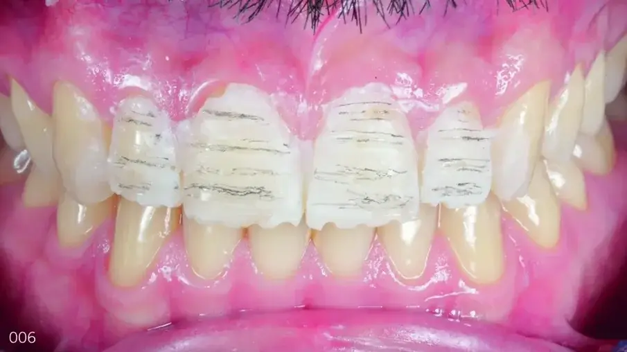 Фиг. 6 Ориентировъчни срезове, маркирани с молив за калибрирана препарация предимно за композита.