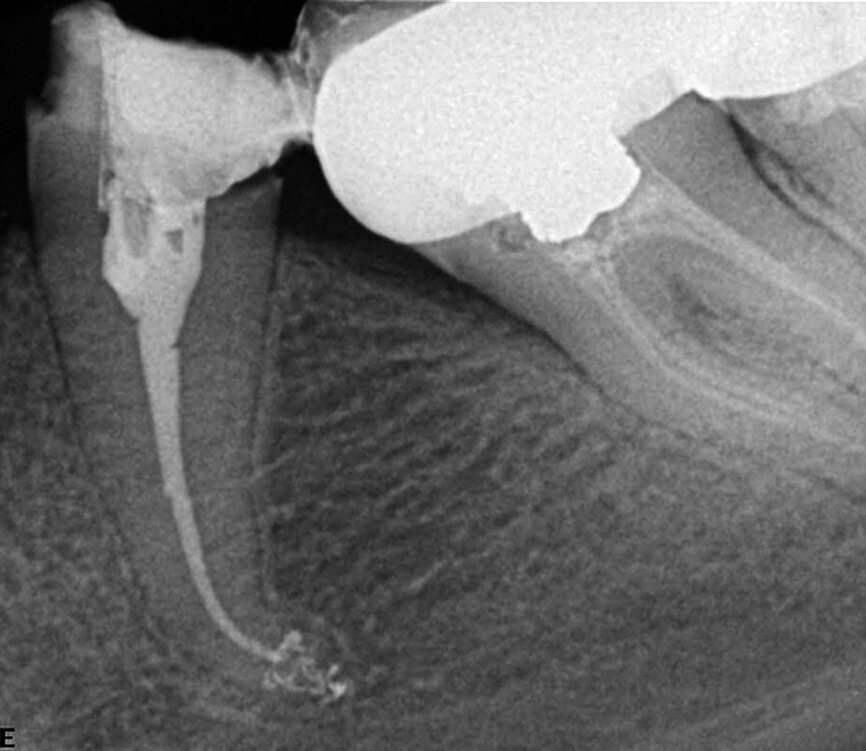 Fig. 4: Complexity of the apical area manifests itself after it was treated chemically, dried, and sealed by way of the warm vertical technique.