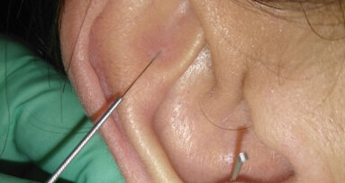 Agopuntura nel trattamento della SLA: implicazioni sistemiche e oro-faringee