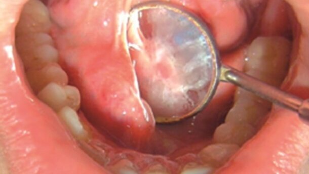 Leczenie zachowawcze dużych kamieni gruczołów ślinowych w śliniance podżuchwowej