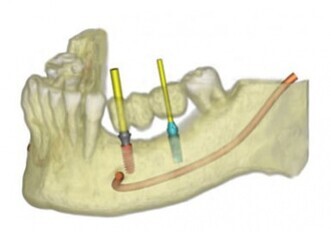 SimPlant 2011 – Fast and easy 3D implant treatment planning