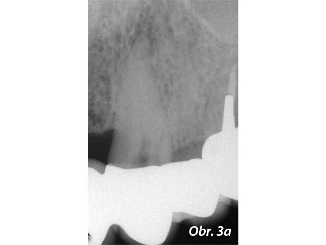 Radiolucence v krčkové části špičáku