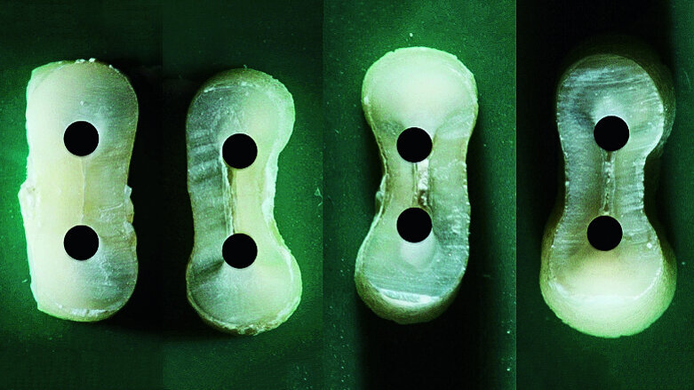 Dentinal defects after root canal preparation