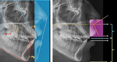 Acotaciones al uso de la cefalometría