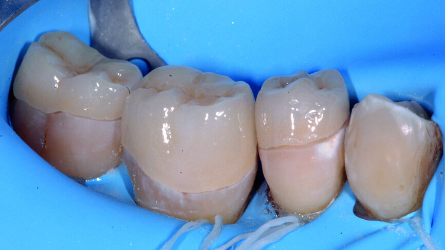 Figs. 10a & b : Essayage