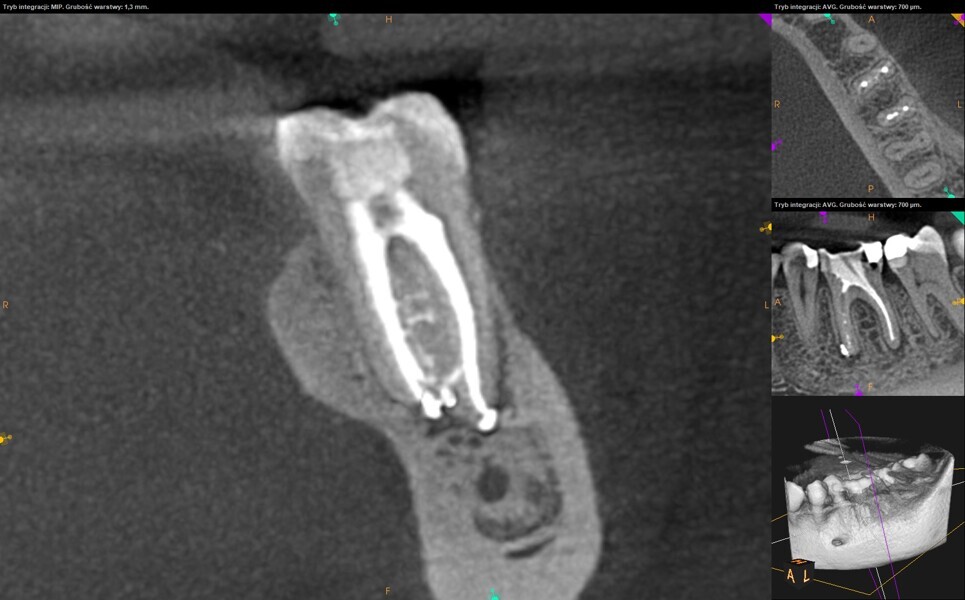 Fig. 36: Post-op CBCT image showing the great amount of sealer extrusion at the lateral portals of exit.