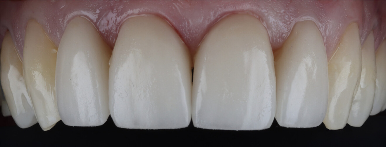 Fig. 11: Clinical try-in of the veneers using PANAVIA V5 try-in paste Universal (A2) to assess fit and shade integration.