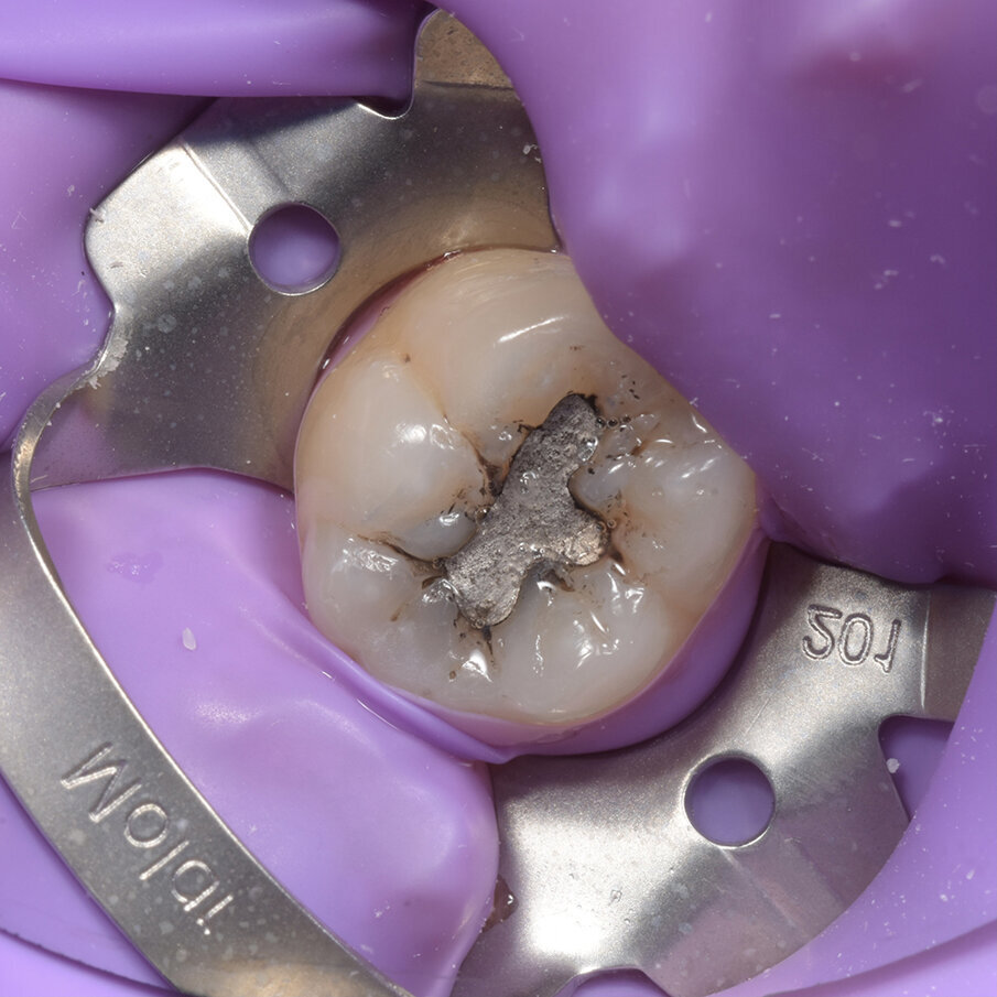 Fig 2: Rubber dam isolation  