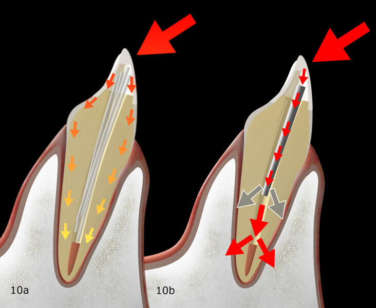Figs. 10a & b: Schematic representation of the stress distribution in an endodontically treated tooth restored with rigid prefabricated posts (a) and fibre-reinforced flexible posts (b).