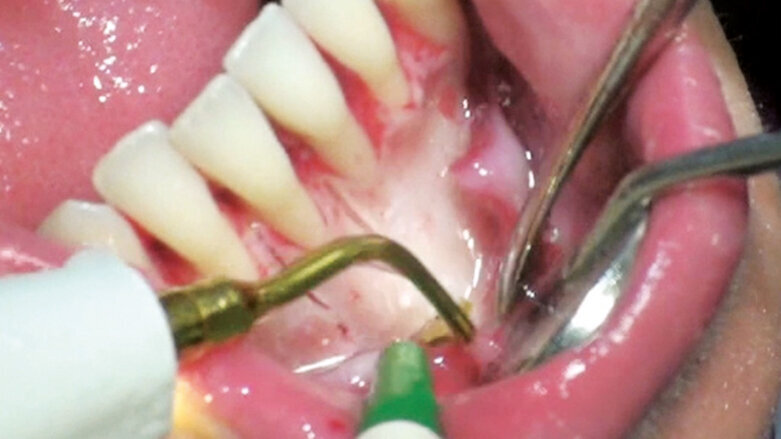 Šest klíčů pro účinné využití alveolární kortikotomie