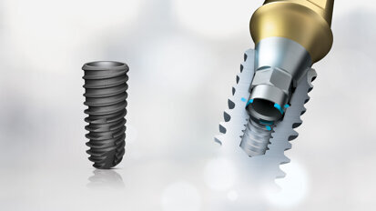 KS system: Key solution for strong dental implants KS system: Key solution for strong dental implants