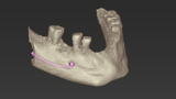 coDiagnostiX-3D visualization of the bone