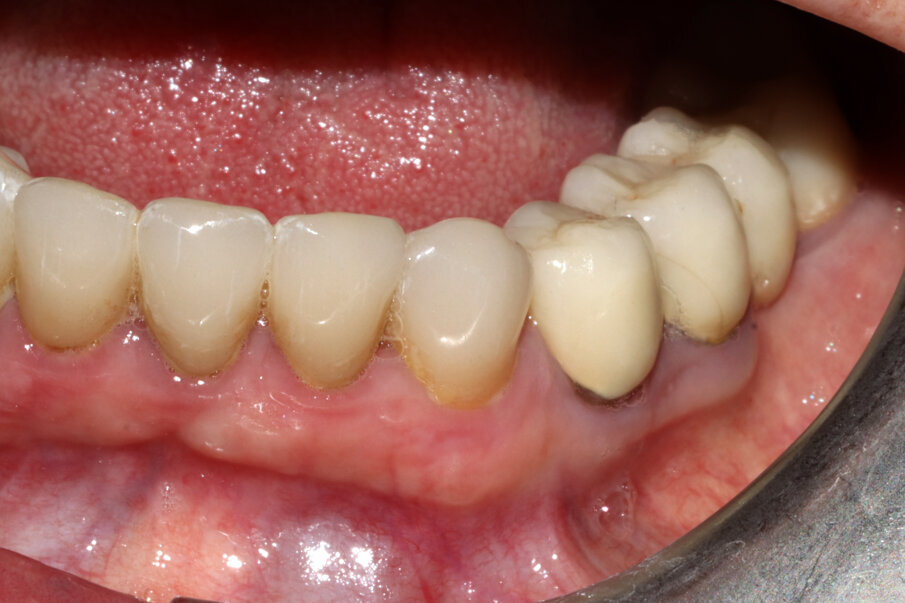 Fig. 3_Il caso clinico descritto: elemento 3.3 già rivestito di corona protesica, vitale e dolente.