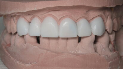 Le  mock-up, un outil quotidien en esthétique dentaire