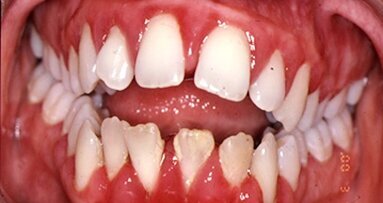 Les bactéries de la bouche accélèrent le développement de la maladie des gencives