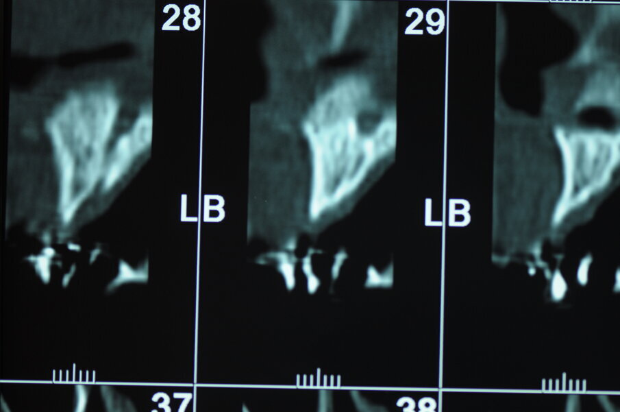 Figg. 3, 4 - Valutazione dei volumi ossei all'esame TC.