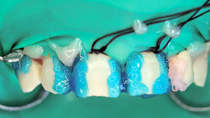 Multidisciplinární přístup s Er,Cr:YSGG laserem – Estetický management tvrdých a měkkých tkání