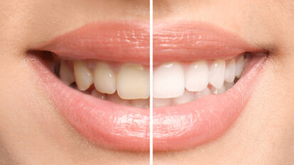 Beyond cosmetics to care: Biocompatible tooth whitening