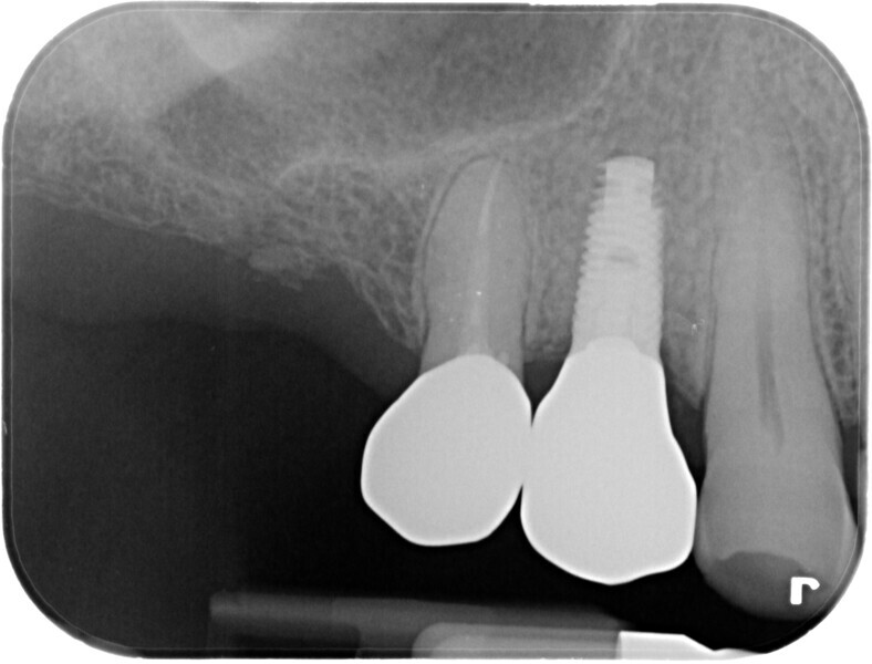 Fig. 24: Final periapical radiograph, showing the good fit and no excess cement.