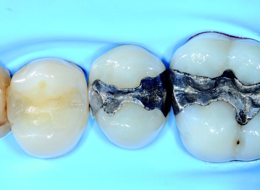 Dental elements are isolated with rubber dam to avoid contamination of the area and improve visibility.