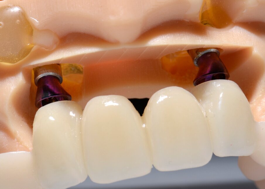 Fig. 49 - Provvisorio e SRA.