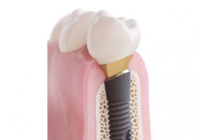 Dentsply Sirona – OsseoSpeed Profile implants
