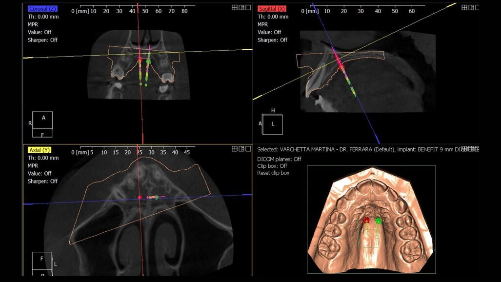 Il workflow digitale per la correzione della discrepanza trasversale: un case report
