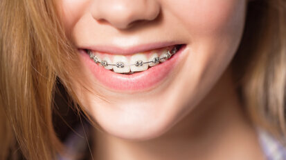 WGKK zieht Bilanz: Zwei Jahre Gratiszahnspange ist ein Erfolg