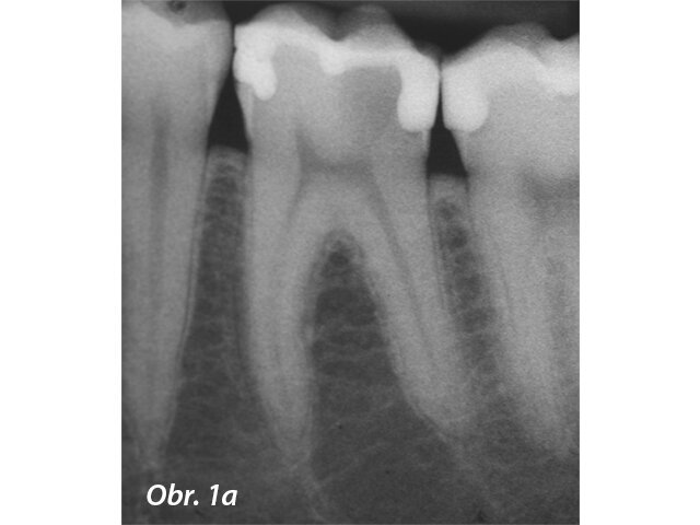 Hluboká kariézní léze