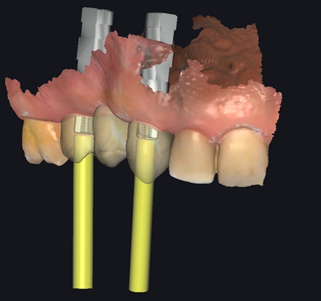 Figs. 6–8: Design of the final restoration.