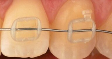 Des chercheurs espagnols développent une nouvelle génération de brackets invisibles