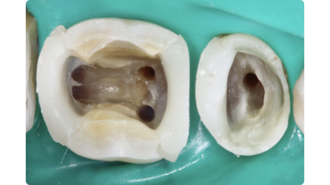 Fig. 11: Teeth #45 and 46 shaped and cleaned, ready for obturation of the root canal system.