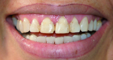 Ceramic and composite resin integration for custom smile design