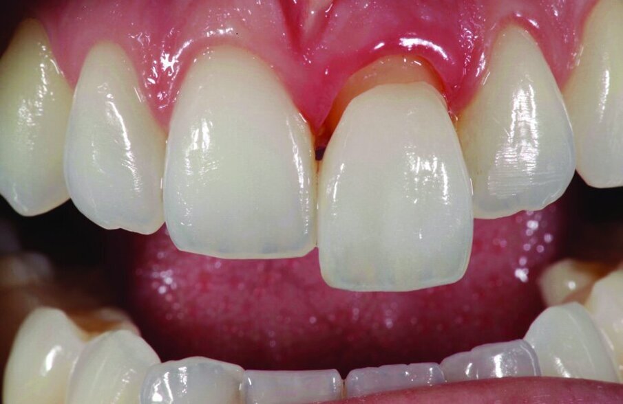 Figs 4, 5, 6 and 7: The versatile range of IPS e.max Ceram materials allows you to imitate bleached tooth shades showing lifelike light reflection.