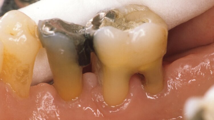 Kariogene bakterije proizvode supstance koje podstiču toleranciju na kalcijum