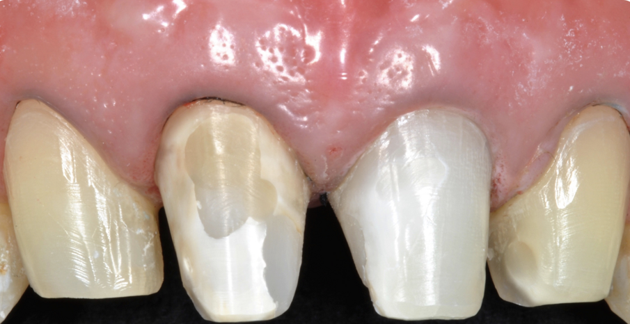 Fig. 12 - Trascorsi 7 mesi dalla chirurgia e dalla risoluzione del problema endodontico, si è proceduto con la preparazione a butt-joint del 12 e del 22 per ricevere due faccette e delle preparazioni complete a finire su 11 e 21 per le due corone monolitiche in disilicato.