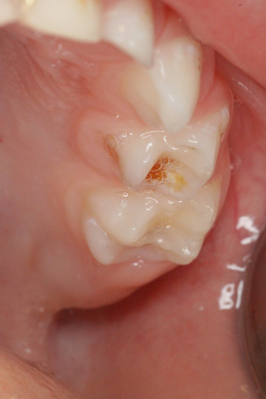 Afbeelding 3c. Cariëslaesie 64 na een half jaar nog actief.