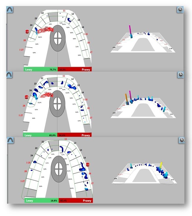 Ryc. 6_T-scan wykonany 2 tygodnie po zabiegu i 7 miesięcy po zabiegu oraz po korekcie wypełnień i uzupełnień protetycznych.