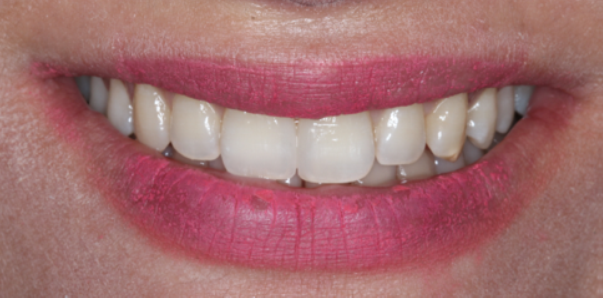 Fig. 17: Completed diastema closure