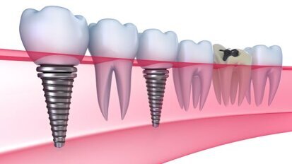 Nieuwe coating verbetert bothechting aan implantaten