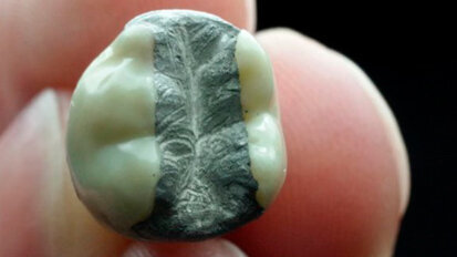 Medicine alternative per far fronte ai problemi dell’amalgama dentale