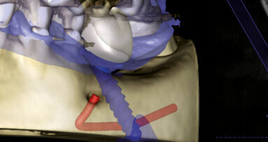 Plně navigovaná implantace – efektivní řešení při nedostatku kosti