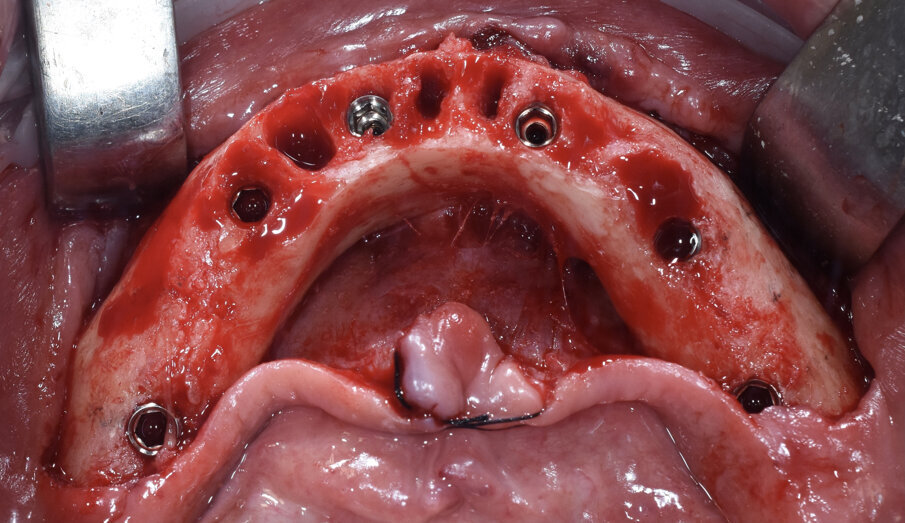 Fig. 8 - Inserimento 6 impianti assiali.