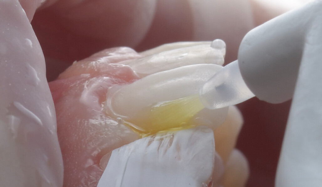 Fig. 11: Application of CLEARFIL Universal Bond Quick.