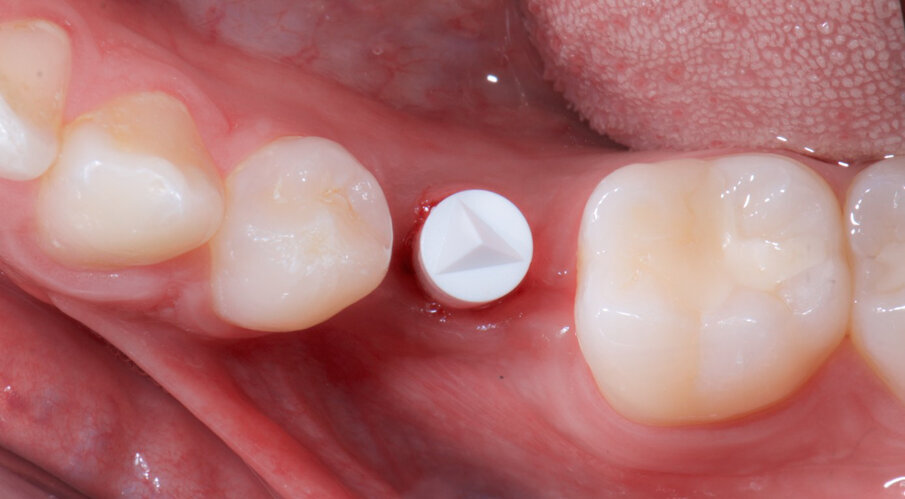 Fig. 5a_Gli scan body avvitati.