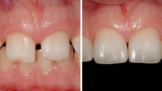 Aesthetic rehabilitation: Webinar discusses indications, limitations and clinical procedures