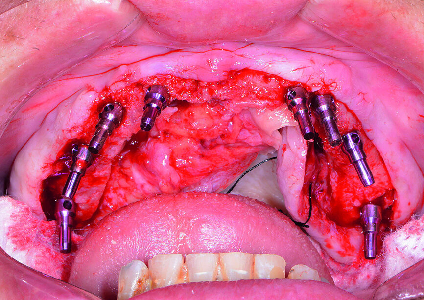 Fig. 10: Paralleling pins placed.