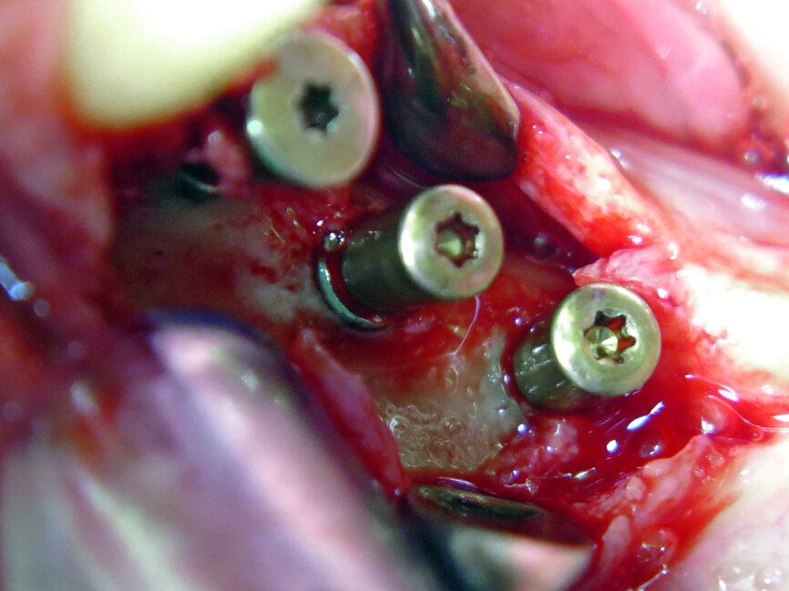 Fig. 5: New bone around implants.