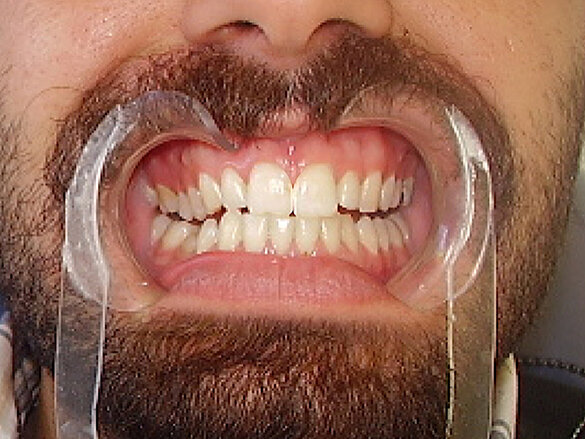 Figura 3. Cierre de diastema digital.